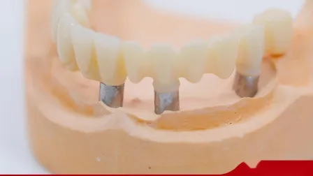 Couronne d'implant dentaire réalisée sur des modèles imprimés en 3D